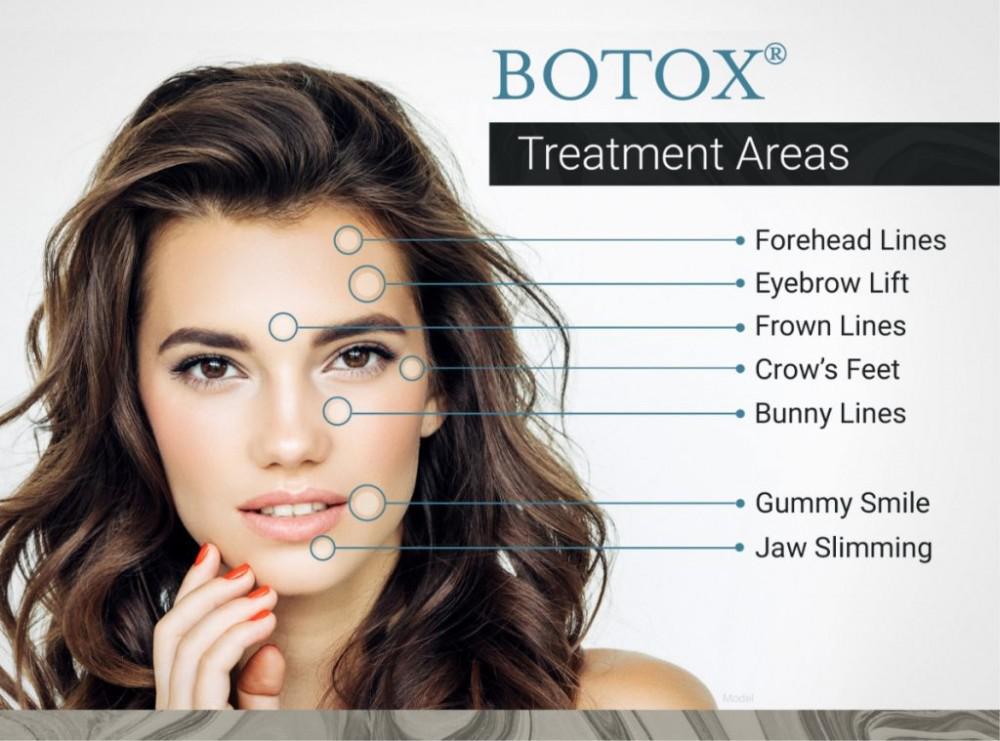 What you need to know about Botox